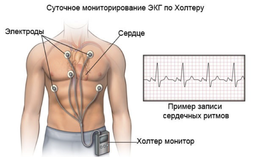 Как проходит холтеровское мониторирование Как проходит холтеровское мониторирование
